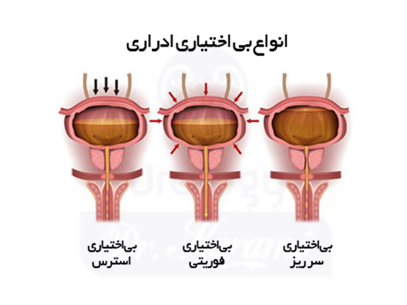 داروی گیاهی طب سنتی برای بی اختیاری ادرار