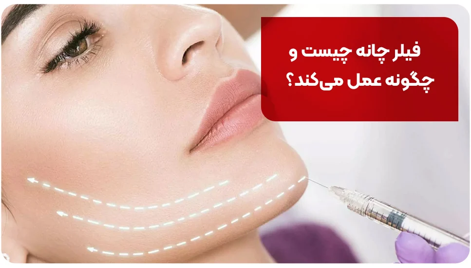 فیلر چانه چیست و چگونه عمل می&zwnj;کند؟