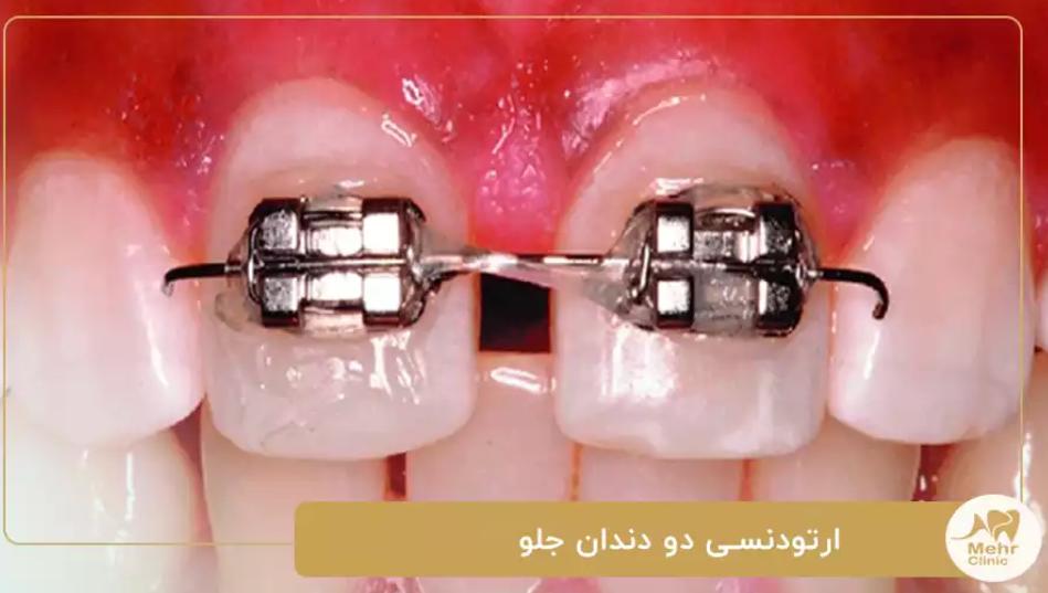 دندانپزشکی کلینیک دندانپزشکی مهر شریعتی؛ درمان سریع و زیبایی بخش ارتودنسی برای دو دندان جلو